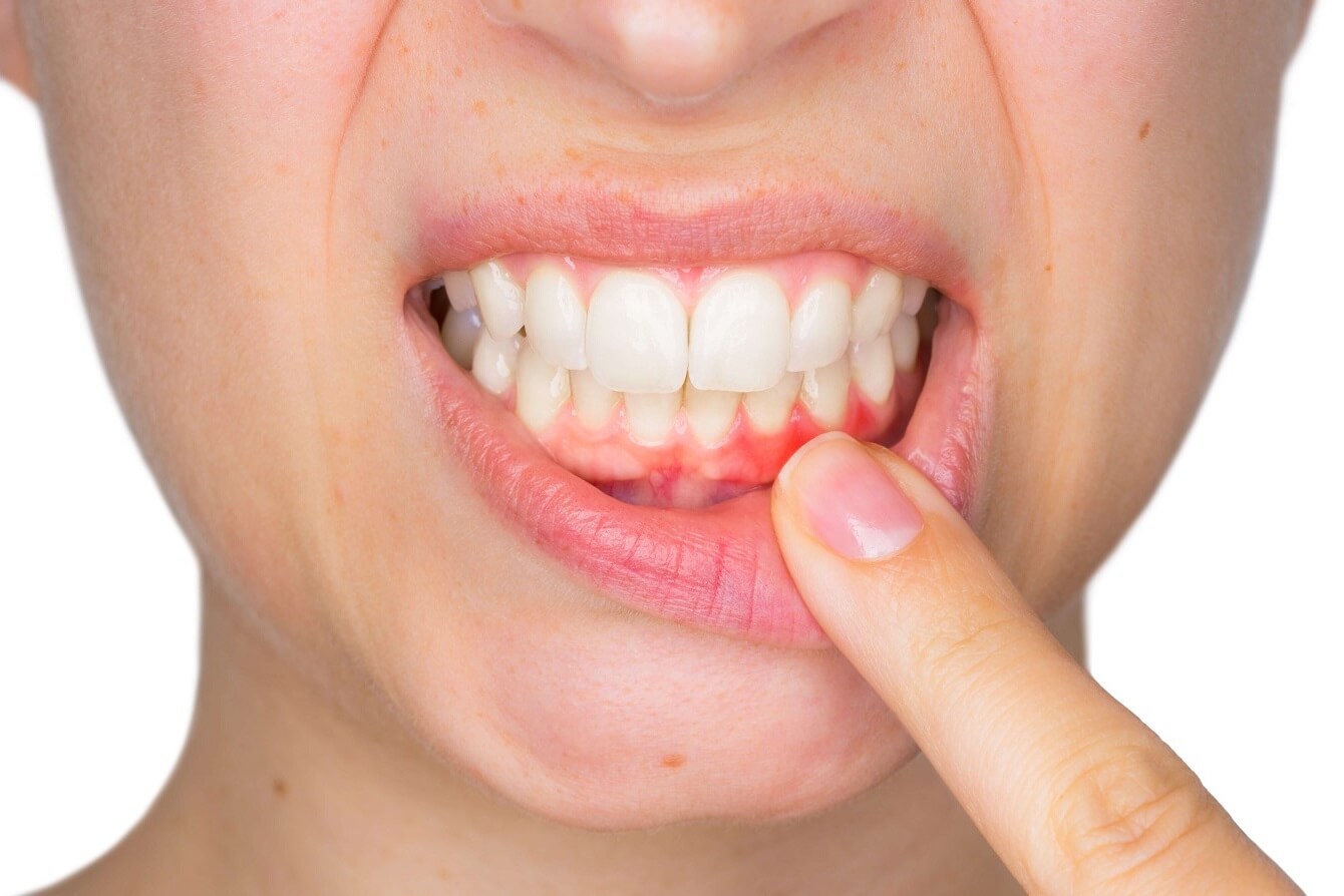 gingivitis-vs-periodontitis-the-importance-of-gum-health-beautiful