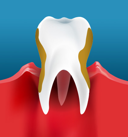 BeautifulSmiles-Periodontal Disease