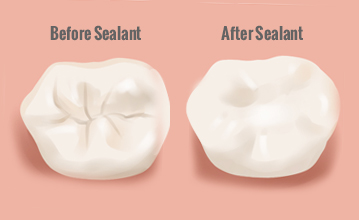 Image result for sealants dental